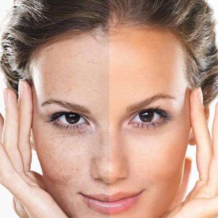 Tratamiento peeling químico Pamplona